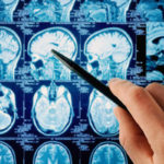Tanulmány: A kannabidiol (CBD) meggátolja az agytumort
