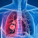 A kannabidiol (CBD) növelheti a tüdőrák fogékonyságát a speciális ölősejtekre