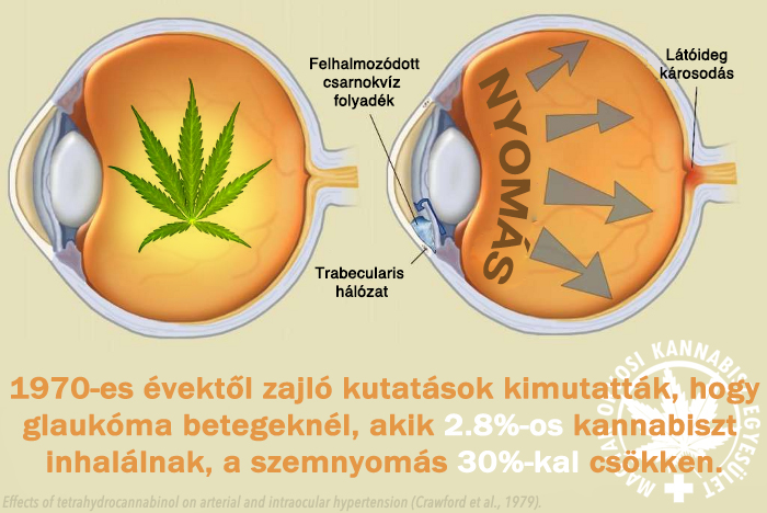 magas vérnyomású glaukóma)
