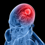 Tanulmány: A CBD fokozhatja a kezelés hatékonyságát a glioblasztóma multiforme (agydaganat) esetén